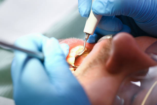 Best Emergency Tooth Extraction in Gardnerville, NV